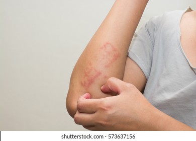 ill allergic rash dermatitis eczema skin of patient