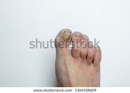 ill, injured toe, yellow nails in a damaged, feminine foot isolated on a white background