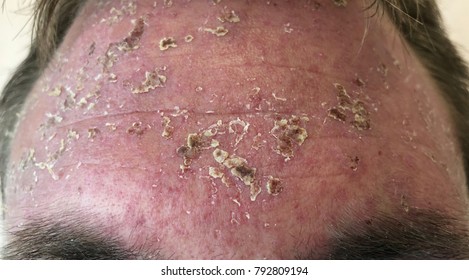 Ill-define Erythematous Rash With Thick Yellow Crust At Forehead In Case Penicillin Allergy.