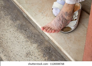 Herpetic whitlow on bottom of foot join. happens Agree, herpetic whitlow on bottom of foot