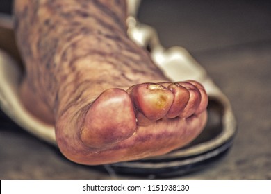 Message, matchless))), herpetic whitlow on bottom of foot This excellent herpetic whitlow on bottom of foot