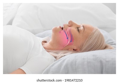 Illustration showing airway during obstructive sleep apnea - Powered by Shutterstock