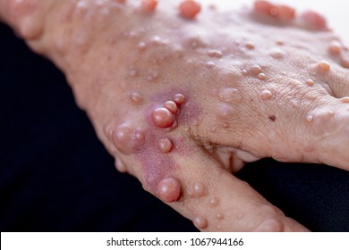 Neurofibromatosis (NF) là tình trạng các khối u phát triển, các triệu chứng bao gồm các đốm nâu nhạt trên da.