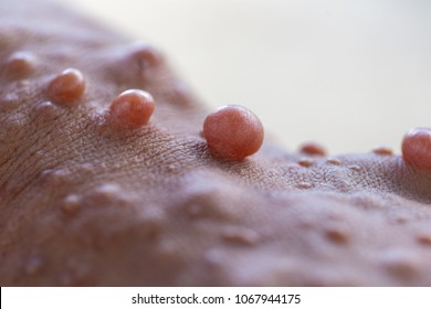 Neurofibromatosis (NF) là tình trạng các khối u phát triển, các triệu chứng bao gồm các đốm nâu nhạt trên da.