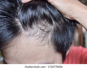 Ausdünnendes oder spärliches Haar, Haarausfall mit männlichem Muster und kahle Stirn im südostasiatischen, chinesischen birmanischen jungen Mann. Frühes Haarausfall in jungen Jahren. Seitenansicht.