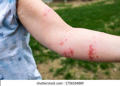 Severe poison ivy/poison oak rash and reaction on woman's arm. Oozing and blisters from poisonous plant.