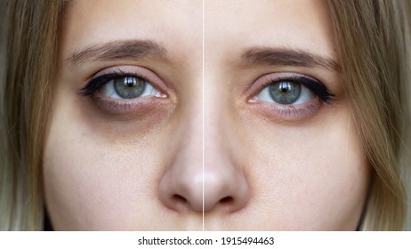 メイクで若い女性の顔のショットをトリミングしました。美容治療の前後に目の下にあざがある女性の緑の目。目の下のくま