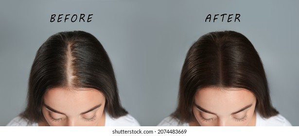 Mujer con problema de pérdida de cabello antes y después del tratamiento con fondo gris, collage. Tricólogo visitante