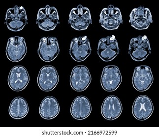 RM DELL'ECCELLENZA E DELL'ORBITA Reperto: lesione cistica ben definita con proiezione papillare interna nella parte mediale, occupante i compartimenti intra ed extraconici dell'orbita sinistra. Concetto medico.