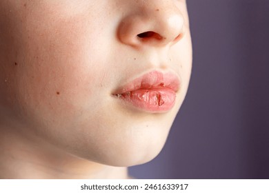 Pamje nga afër e një fëmije me buzë të thata dhe një çarje buzësh të përgjakur. Kujdesi për buzët. Fokus i butë.