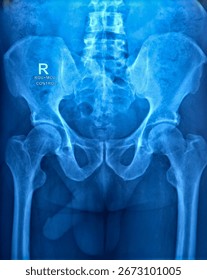 Radiografie a RGU și MCU. Reziduu post-mital (PVR) mic, în rest nu s-a detectat nicio anomalie remarcabilă.