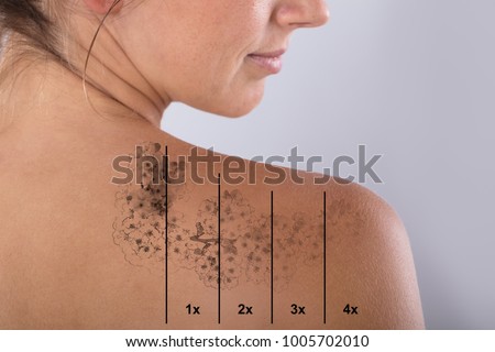 Laser Tattoo Removal On Woman's Shoulder Against Gray Background Royalty-Free Stock Photo #1005702010