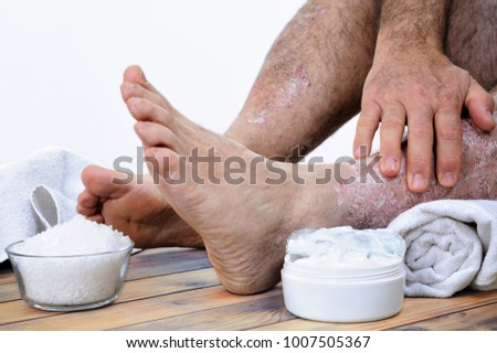 A person suffering from chronic psoriasis relaxes during treatment with salts and creams of inflammation on an antique wooden table.