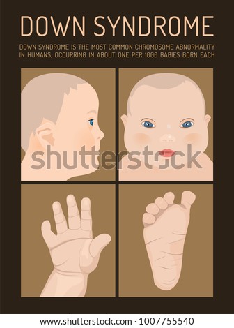 Symptoms of down syndrome poster. Abnormal ears, short hands, flattened face and nose, heart disease, big toes widely spaced. Vector illustration in beigeand brown colors with little child image. Royalty-Free Stock Photo #1007755540