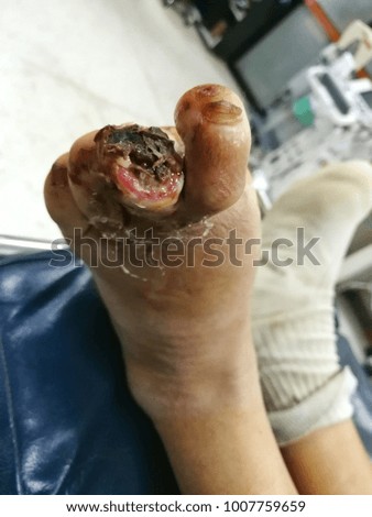 infected foot, diabetic patient