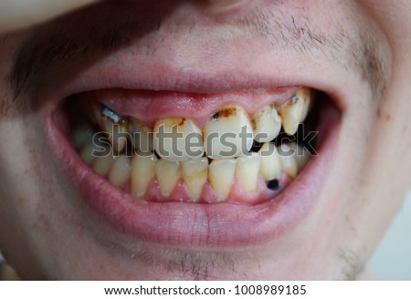 issues for Oral Care, Caries, tartar, gum disease, dental problems, bad teeth dental problems Royalty-Free Stock Photo #1008989185