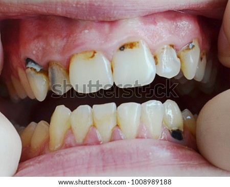 issues for Oral Care, Caries, tartar, gum disease dentistry Royalty-Free Stock Photo #1008989188