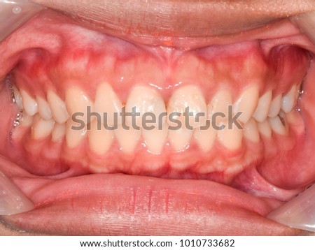Intra-oral picture of teeth and gum in the mouth (oral care) when smile 