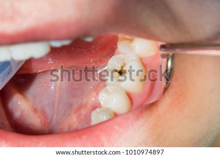 close-up of a human rotten carious tooth at the treatment stage in a dental clinic. The use of rubber dam system with latex scarves and metal clips, production of photopolymeric composite fillings Royalty-Free Stock Photo #1010974897