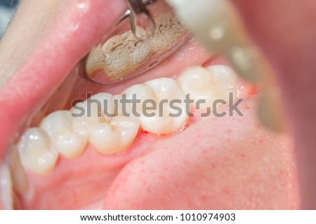 close-up of a human rotten carious tooth at the treatment stage in a dental clinic. The use of rubber dam system with latex scarves and metal clips, production of photopolymeric composite fillings Royalty-Free Stock Photo #1010974903