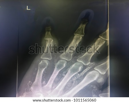 X-ray left hand show bone dislocate at little finger with space for your text and design. Concept be used for present part of bone and organ for medical and hospital. Blur picture with grain film.