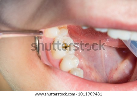 close-up of a human rotten carious tooth at the treatment stage in a dental clinic. The use of rubber dam system with latex scarves and metal clips, production of photopolymeric composite fillings Royalty-Free Stock Photo #1011909481