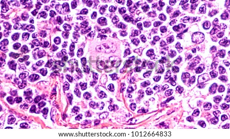 Photomicrograph of a lymph node in a patient with Hodgkin's Disease (lymphoma), showing a Reed Sternberg cell variant. Royalty-Free Stock Photo #1012664833