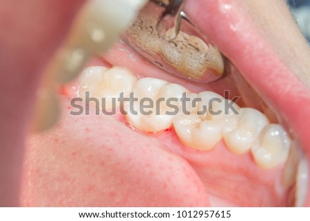 close-up of a human rotten carious tooth at the treatment stage in a dental clinic. The use of rubber dam system with latex scarves and metal clips, production of photopolymeric composite fillings Royalty-Free Stock Photo #1012957615
