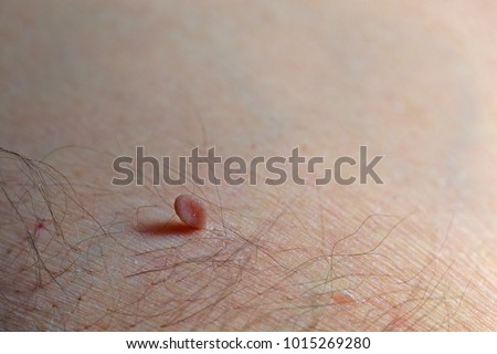 Large brown skin tag attached to the hairy armpit of a man held on by a small section of the tag. Selective focus with space for text. Royalty-Free Stock Photo #1015269280