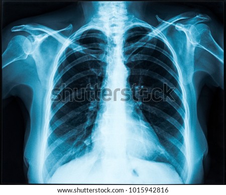 Woman thorax x-ray for lungs examination Royalty-Free Stock Photo #1015942816