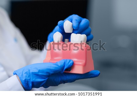 Real doctor holding model of teeth with dental implant, closeup. Tooth restoration. Installation of the dental implant. Dental prostheses. Artificial teeth with steel pin. Oral care and dentistry. 