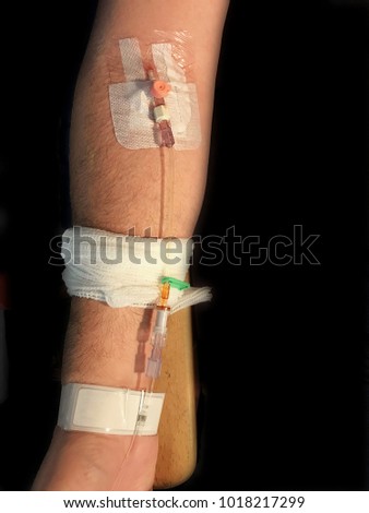 Cannula inserted into the inside of the elbow of a man and stuck down with a plaster and tape. The tube extends to another section. Man resting arm on chair. Cannual used for inserting iv fluids.