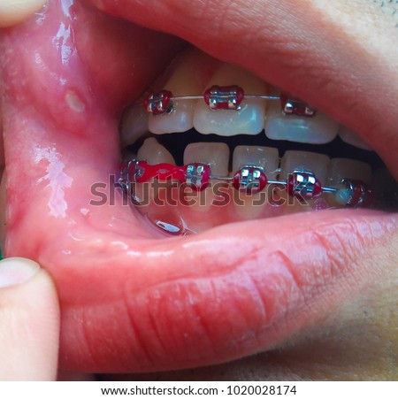 mouth ulcer is an ulcer that occurs on the mucous membrane of the oral cavity. Mouth ulcers are sores that appear in the mouth, often on the inside of the cheeks. Royalty-Free Stock Photo #1020028174