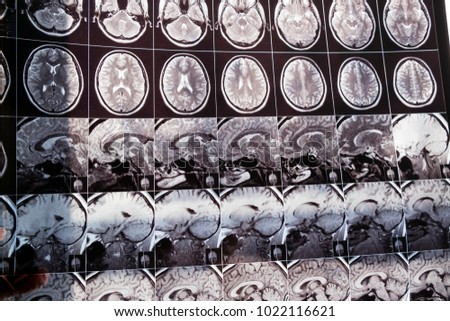 Closeup of a CT scan and skull on it. health medical image of an mri of the head showing the brain different projections. Magnetic resonance imaging. examines film x-ray patient.