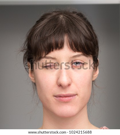 Woman with facial hemiparesis
