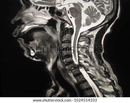 MRI Cervical spine Suspected unilateral interfacetal dislocation at C6-C7 vertebrae,with spinal myelopathy at C6-7 levels,abnormal high signal intensity on T2WI and STIR- 
along spinal myelopathy Royalty-Free Stock Photo #1024554103