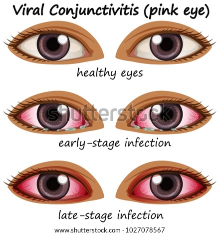 Viral conjuctivitis in human eyes illustration