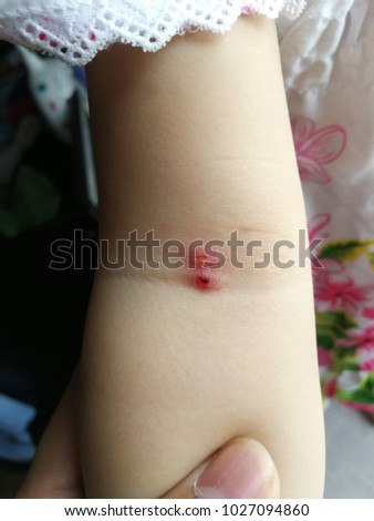 healing insect bed bug bit on the arm of a baby