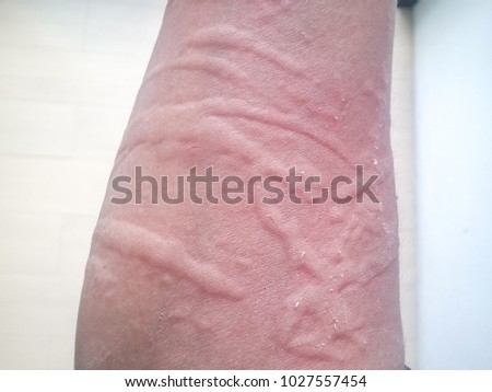Healthcare Picture background of congenital disorder of thai or asian people,Closeup  image of symptoms of itchy urticaria or rash on arm with blurred floor background.