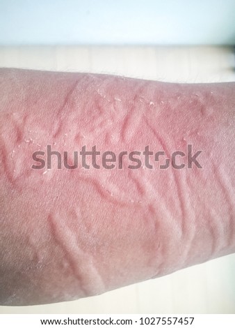 Healthcare Picture background of congenital disorder of thai or asian people,Closeup  image of symptoms of itchy urticaria or rash on arm with blurred floor background.