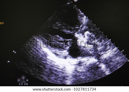 Echocardiogramp ,Image from modern medical equipment, ultrasound machine, sonograph, 
