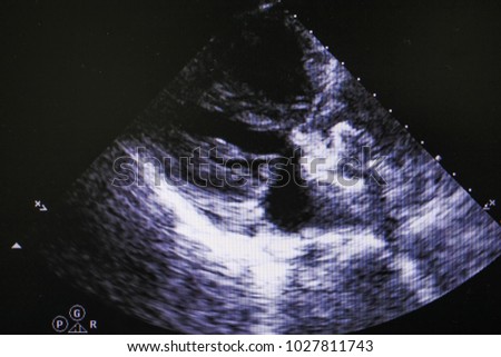 Echocardiogramp ,Image from modern medical equipment, ultrasound machine, sonograph, 