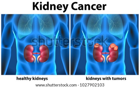 Diagram showing kidney cancer in human illustration