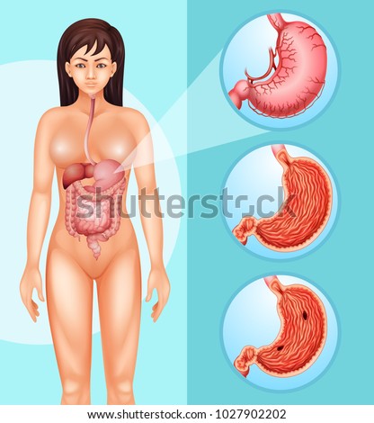 Diagram showing woman and cancer in stomach illustration