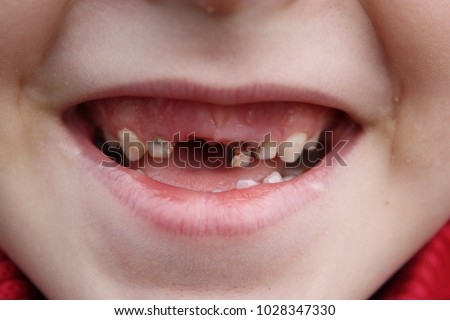 Child's open mouth smiling. Problem in caries of baby teeth. Different stages of disease - this damage to enamel of teeth. Close-up photo of baby tooth loss flyer elements stomatology healthcare theme Royalty-Free Stock Photo #1028347330