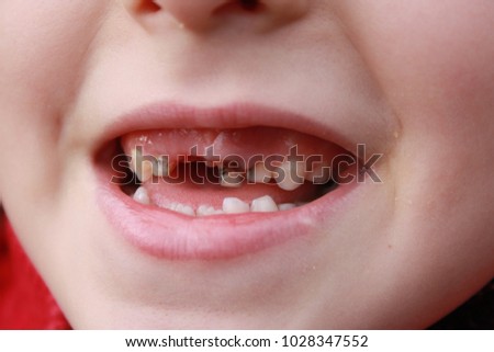 Child's open mouth smiling. Problem in caries of baby teeth. Different stages of disease - this damage to enamel of teeth. Close-up photo of baby tooth loss flyer elements stomatology healthcare theme Royalty-Free Stock Photo #1028347552