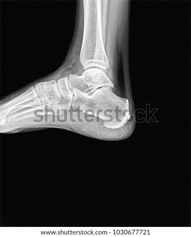 Man right ankle x-ray. Side scan.