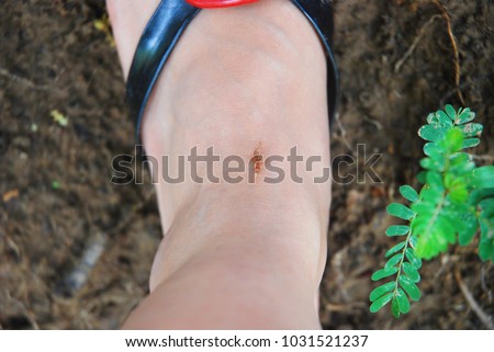 A girl's foot on red ant bite