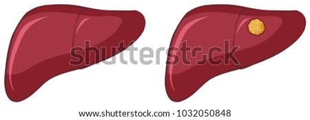 Cancer in human liver on white background illustration