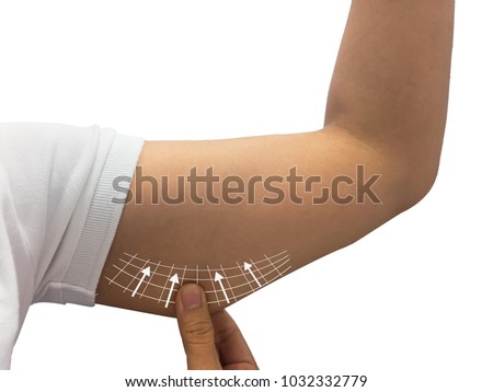 female skin on her upper arm and about to perform liposuction, Tricept , Lose weight and liposuction cellulite removal concept Royalty-Free Stock Photo #1032332779